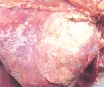 圖1：肺臟全面性佈滿大小約 0.2 × 0.2cm，多發黃白色乾酪樣壞死灶，有肺葉實質並有一較大區域約 5×5cm 大小之黃白色壞死區，肺臟表面並呈現粗糙及纖維素粘連。