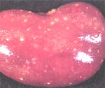 圖2：腎臟表面與實質亦全間性佈滿大小約 0.2×0.2 公分，多發黃白色壞死灶。
