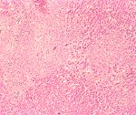 圖3：肝臟實質部呈現多發到融合性的壞死灶，於壞死灶中常可見到巨噬細胞，淋巴球和藍罕氏巨大細胞（Langhant