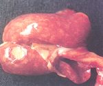 圖1：肺臟全面具有許多瀰漫散發細小的黃白色壞死灶，且於左膈葉與心葉具有二處約 0.3×0.3 與 0.5×0.5cm 較大之壞死區。