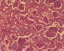 圖2:嚴重病例肺臟到處可見壞死凝固物，壞死的巨噬細胞沈積於肺泡腔中，肺泡壁增厚並有單核炎症細胞浸潤且其內襯也出現嚴重第Ⅱ型肺泡上皮細胞的增生。