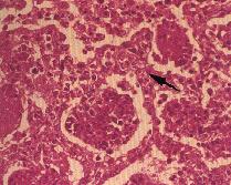 圖3:高倍下，如圖 2所述的病變，另可明顯看到第Ⅱ型肺泡上皮細胞的增生(箭頭所指)