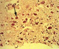 圖3：大腦局部性壞死，變性的神經細胞內有嗜酸性核內包涵體(箭頭)。