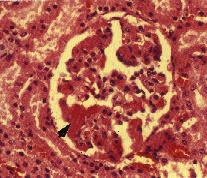 圖2： 豬，腎組織相。敗血(症)型沙氏桿菌症。鏡下，腎絲球之微血管間隙有血栓蓄形成。(箭頭)