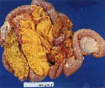 圖4： 豬，大腸。慢性腸炎型沙氏桿菌症。圖中大腸擴張，漿膜層粗糙，腸繫膜水腫樣變化而粘膜層可發現明顯的乳黃色纖維素塊覆蓋其上。(箭頭)