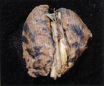 圖2：兩肺的各肺葉散佈著十多個大小與形狀不一的青灰色到黑色的病灶，其表面平坦而光滑。