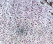 圖4： 腫瘤細胞多呈紡錘形，細胞質兩端細而長，各細胞之間所含色素差異很大，成熟的細胞質含較豐富的棕黃色細小顆粒。細胞核很大，呈橢圓或長條形，具有一至數個明顯的核仁。有絲分裂甚為普遍。 