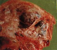 圖１：顱腔之腦膜佈滿典型乾酪化壞死結節