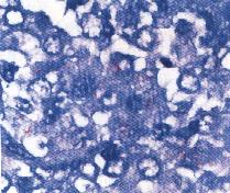 圖4：病灶區經抗酸染色可見紅色之分枝桿菌 (Acid-fast stain)。