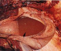 圖3：膀胱粘膜充血，內含有黃色顆粒狀膿樣物。(箭頭)
