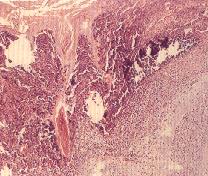 圖2：部份表皮及真皮組織可見大量藍染炎症細胞、壞死細胞及細菌團塊浸潤。