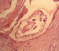 圖3：具幾丁質外骨骼之寄生蟲寄生於表織可見角化不全及角化過度現象。