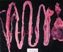 圖2：腸管集淋小結發生嚴重出血潰瘍。