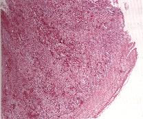圖3：盲腸扁桃嚴重出血潰瘍。H & E stain ，X400