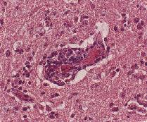 圖4：腦部血管呈淋巴球圍管現象(箭頭)血管內皮細胞肥厚增生。H & E stain，X200  