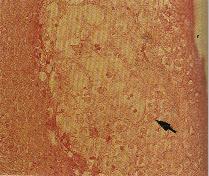 圖2：皮膚組織切片：上皮細胞增生，近表面之增生細胞腫脹後變大，而在上皮細胞之細胞質內可見粉紅色之嗜酸性包涵體(箭頭)
