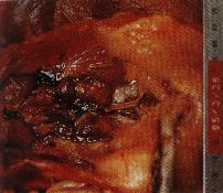 圖1：腎腫大褪色，可見白色尿酸鹽沉著。