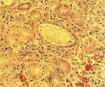 圖2：腎組織切片：腎小管擴張，內含玻璃樣圓柱及脫落之上皮細胞，間質可見圓形細胞浸潤