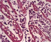 圖4：心肌纖維間可見核呈多形性，大小不一，分裂相當旺盛之淋巴腫瘤樣細胞浸潤。100X，H & E stain