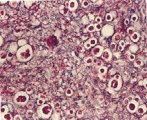 圖4：肝及盲腸內有大量多核巨細胞及位於空腔內之蟲體。蟲體大小不一且可單獨或數個同時存在。(PAS stain, 400X) (箭頭)