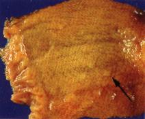 圖1：鴨胃蟲感染症之腺胃粘膜可見白色米粒大結節。