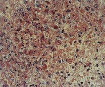 圖5：肝組織切片：多發局部壞死灶、肝竇狀隙明顯擴張。H & E stain X100