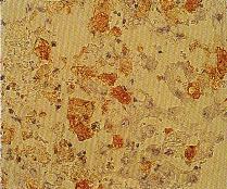 圖8：肝組織切片行ABC 免疫染色，可見黃褐色特異病毒抗原。