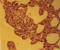 圖2：肺終末小支氣管 (terminal bronchioles)之單層纖毛立 方上皮細胞，逐漸化生為多層狀類纖維上皮細胞，細胞核腫脹，含有多個嗜酸性核內包涵體 (箭頭，H & E stain,X100)。
