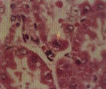 圖4：腎臟近端腎小管上皮細胞含嗜酸性核內包涵體 (H & E stain, X1,000)。