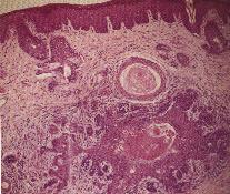 圖2：此腫瘤特徵為單一或多發初級囊泡，開口於表皮，周圍呈放射狀、樹枝狀排列的次級囊泡向外生長，並可見類基底細胞，發育中的毛囊，皮脂腺等不同分化程度的細胞。越分化的次級囊泡，皮脂腺發育越明顯。H &E 染色