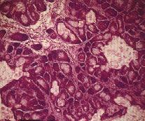 圖3：腫瘤形成不完全的囊泡狀或呈腺管、巢狀結構。中央為嗜伊紅性角質或淡染、透明的分化皮脂腺細胞，周圍為嗜鹼性類基底細胞。(H & E 染色)