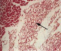圖１：橫紋肌增生症鏡檢下可見疏鬆、淡染、纖維結構間雜有大、空泡樣細胞(箭頭所指)，周圍為正常心肌細胞。(Masson