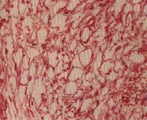 圖3：大，空泡樣細胞，具有一中央或位於周圍的細胞核，某些細胞延著其細胞質邊緣呈淡染，嗜伊紅性，綵帶般至顆粒樣物質，PAS染色呈粉紅至紫紅色(Masson