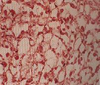 圖4：高倍同上所見。呈海綿泡狀結構，非常大的心肌細胞，及單一、大的細胞質空泡。空泡內大部份為肝糖，但在切片製備時脫色，僅在細胞邊緣遺留一圈嗜伊紅性時脫色，僅在細胞邊緣遺留一圈嗜伊紅性時脫色，僅在細胞邊緣遺留一圈嗜伊紅性細胞質。核呈扁平狹長至圓、卵圓形皆可見(Masson