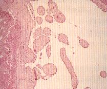 圖3：肺組織切片：肺動脈內膜呈疣狀之增生　H&E stain X40。