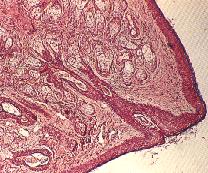 圖3：耳翼內側真皮及皮下有許多皮脂腺之腺體增生部分可見皮脂腺腺管阻塞，致使皮脂腺腺體細胞肥大或管徑擴大。