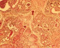 圖4：耳翼內側真皮及皮下有許多耵聹腺之腺體增生，大部分耵聹腺腺管阻塞使管徑擴大且細胞壞死。壞死區周圍有脂褐質沈積。100X H & E。ABC 免疫染色，可見棕色的陽性反應出現於肺泡腔的凝固物和壞死巨噬細胞的細胞質。