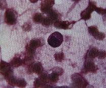 圖1：血液抹片下，可見單核球細胞質中有一明顯、緻密的艾利希體包涵體。