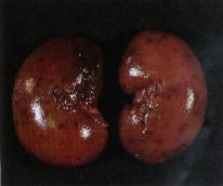 圖4：腎臟表面可見多發的出血點。