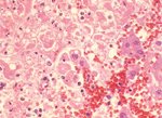 圖3：肝組織切片，局部凝固樣壞死灶，壞死之肝細胞內可見嗜酸性核內包涵體。