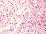 圖4：肺呈間質性肺炎，肺泡巨噬細胞增生，於變性、壞死之支氣管上皮細胞及肺泡巨噬細胞內可見嗜酸性核內包涵體。