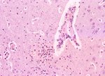 圖4：大腦組織切片呈非化膿性腦炎，可見淋巴球圍管，小神經膠細胞聚集及血管內皮細胞增生及腫脹等病變。