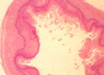 圖2：小腸粘膜層及粘膜下層壞死，其間有許多變性炎症細胞和細菌團塊浸潤