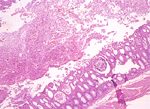 圖2：腸粘膜絨毛萎縮，腸腔內可見纖維素性滲出物及炎症反應。腺窩擴張，內含脫落之上皮細胞及炎症細胞，腺窩上皮呈扁平狀。