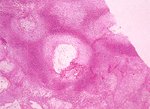 圖2：化膿性纖維素性關節炎，於關節腔內可見大量炎症細胞（以嗜中性球為主）及壞死細菌團塊物浸潤，滑液囊組織呈多發局部壞死灶，於壞死區內亦可見纖維素性炎症滲出物聚集。