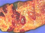 圖2：胎盤絨毛膜水腫，子葉充血、出血。
