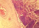 圖3：胎盤絨毛膜可見深層的血管炎。