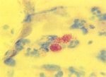 圖5：陰道抹片用Macchiavello 改良法染色可見細胞質內病原體。