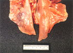 圖1：左側膈葉可見一約 0.8 公分之化膿灶。