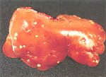 圖2：肝臟散發膿膜包被之局限性黃白色化膿灶，直徑大小約 0.2～0.8 公分不等且分佈於各分葉。